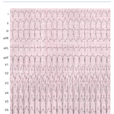 Typical QRS Morphology of Idiopathic Left Ventricular Tachycardia Originating from the Left Posterior Fascicular