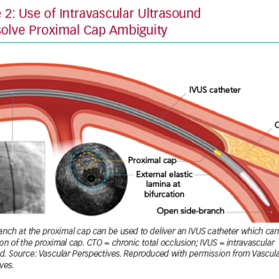 Use of Intravascular Ultrasound to Resolve Proximal Cap Ambiguity