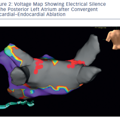 Figure 2 Voltage Map Showing Electrical Silence of the Posterior