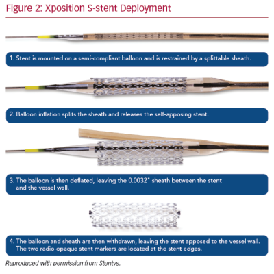Xposition S-stent Deployment