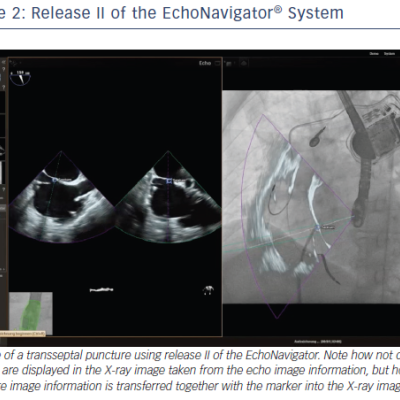Release II of the EchoNavigator® System