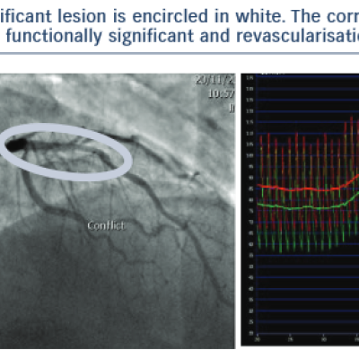 The corresponding FFR measurement of the lesion is 0.72 which renders this stenosis functionally significant and revascularisation iswarranted.