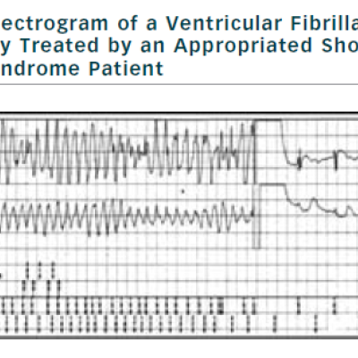 Figure 2 Electrogram of a Ventricular Fibrillation Successfully Treated by an Appropriated Shock in a Brugada Syndrome Patient