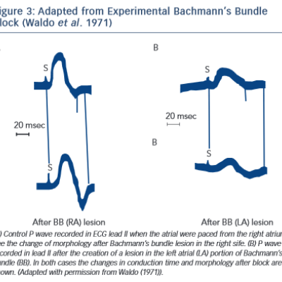 Figure 3 Adapted from Experimental Bachmann’s Bundle Block Waldo et al. 1971