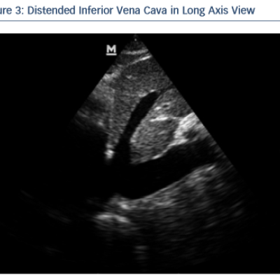 Figure 3 Distended Inferior Vena Cava in Long Axis View