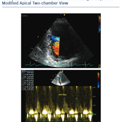 Evaluation of Coronary Flow in Right Coronary Artery Proximal Part Of Posterior Descending Artery from Modified Apical Two-chamber View