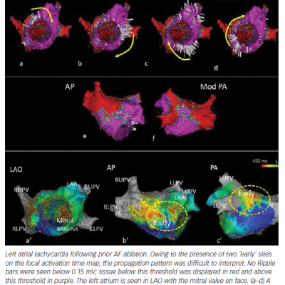 Activation Map Bipolar Voltage Map and Ripple Map of a Post-AF Ablation Atrial Tachycardia
