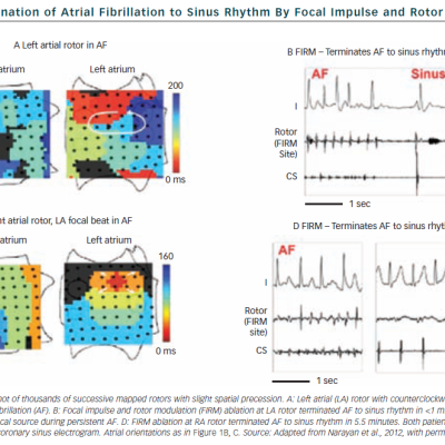 Figure 3 Acute Termination of Atrial Fibrillation to Sinus Rhythm By Focal Impulse and Rotor Modulation Ablation