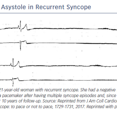 Figure 3 Asystole in Recurrent Syncope
