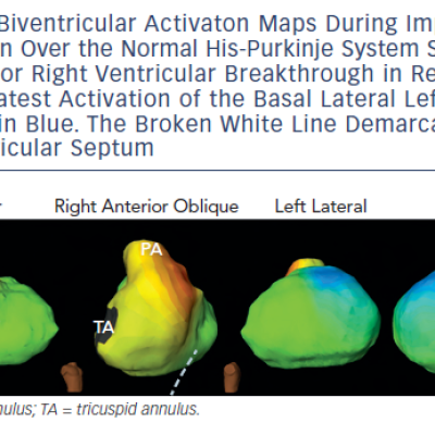 Figure 3 Biventricular Activaton Maps During ImpulseConduction Over the Normal His-Purkinje System Showthe Anterior Right Ventricular Breakthrough in Redand the Latest Activation of the Basal Lateral LeftVentricle in Blue. The Broken White Line Demarcates theInterventricular Septum
