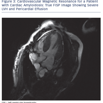 Figure 3 Cardiovascular Magnetic Resonance for a Patient with Cardiac Amyloidosis True FISP Image Showing Severe LVH and Pericardial Effusion