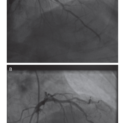 Figure 3 Case Example of a Left Anterior Descending/First Diagonal Bifurcation Lesion Treated with Drug-coated Balloon and Angiographic Follow-up at 4 Months