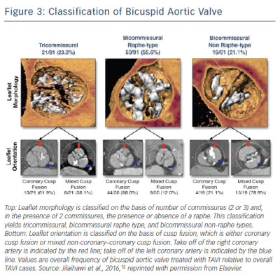 Figure 3 Classification of Bicuspid Aortic Valve