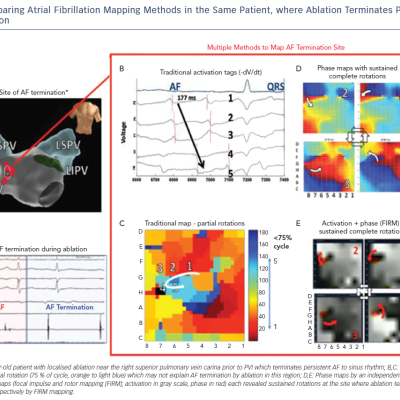 Comparing Atrial Fibrillation MApping Methods