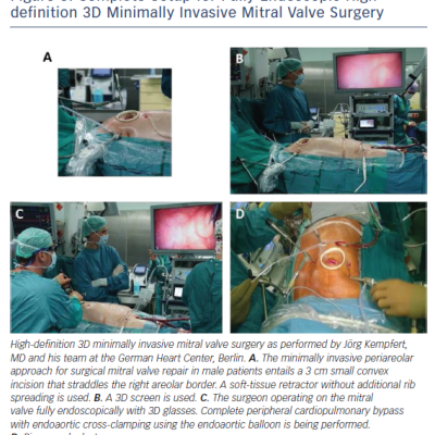 Figure 3 Complete Setup for Fully Endoscopic Highdefinition 3D Minimally Invasive Mitral Valve Surgery