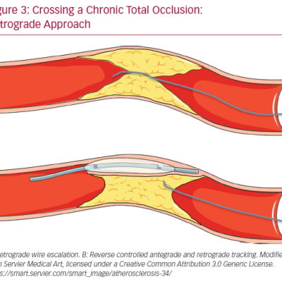Crossing a Chronic Total Occlusion Retrograde Approach