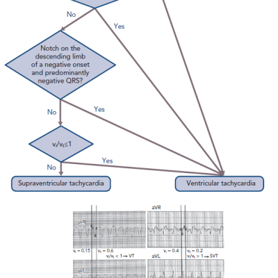 Differential Diagnosis of Wide QRS Tachycardia