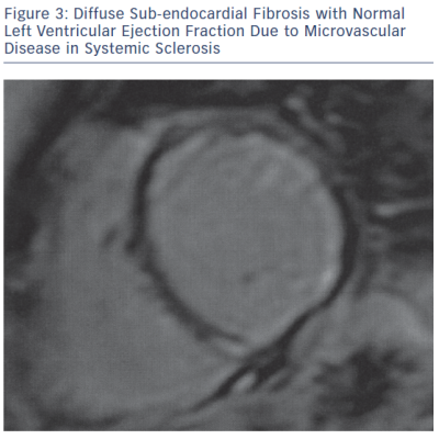 Diffuse Sub-endocardial Fibrosis