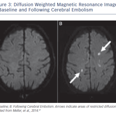 Figure 3 Diffusion Weighted Magnetic Resonance Images at Baseline and Following Cerebral Embolism
