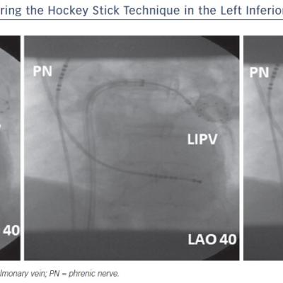 Figure 3 Dynamic Manoeuvring During the Hockey Stick Technique in the Left Inferior Pulmonary Vein