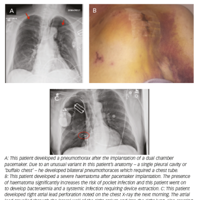 Early Complications of Pacemaker Implantation