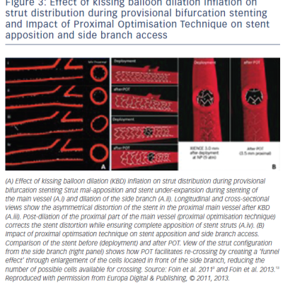 Figure 3 Effect of kissing balloon dilation inflation on strut distribution during provisional bifurcation stenting and Impact of Proximal Optimisation Technique on stent apposition and side branch access