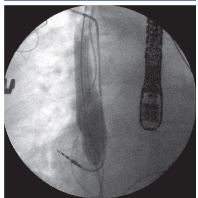 Endovascular Occlusion Ballon