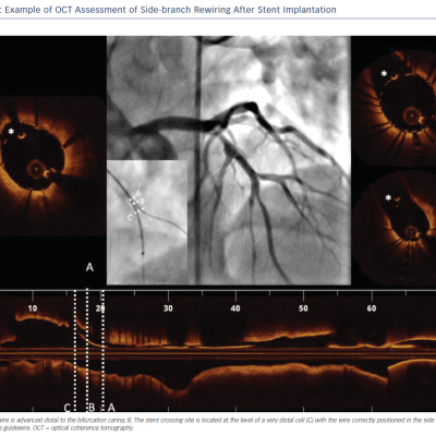 Example of OCT Assessment of Side-branch Rewiring After Stent Implantation