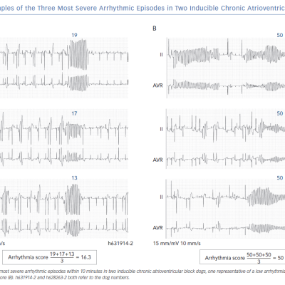 Examples of the Three Most Severe Arrhythmic Episodes