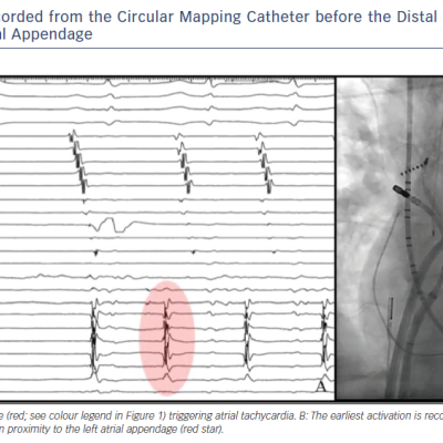 Far-field Activity Recorded from the Circular Mapping Catheter