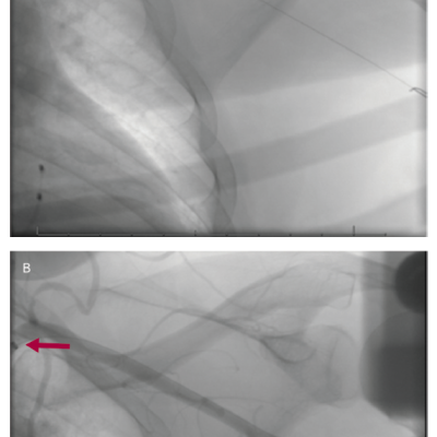 Fluoroscopic Images from Percutaneous Axillary Transcatheter Aortic Valve Replacement