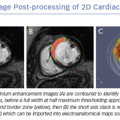 Image Post-processing of 2D Cardiac MRI Images