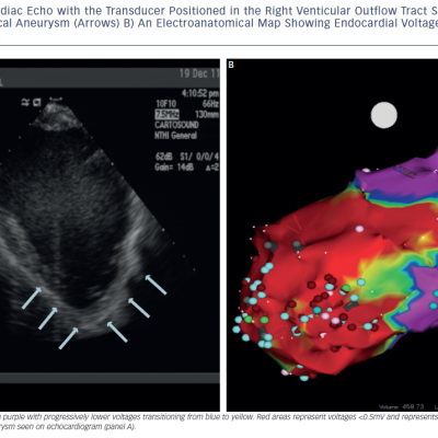 Figure 3 Intracardiac Echo with the Transducer Positioned