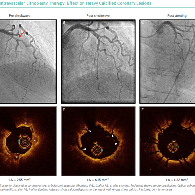 Intravascular Lithoplasty Therapy Effect on Heavy Calcified Coronary Lesions