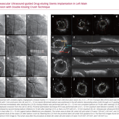 Intravascular Ultrasound-guided Drug-eluting Stents Implantation