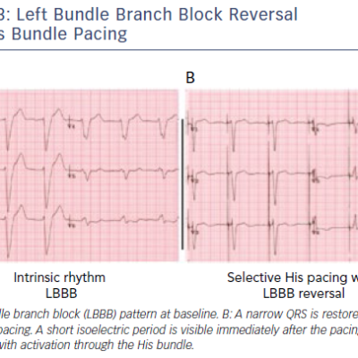 Figure 3 Left Bundle Branch Block Reversal with His Bundle Pacing