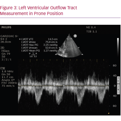 Left Ventricular Outflow Tract Measurement in Prone Position