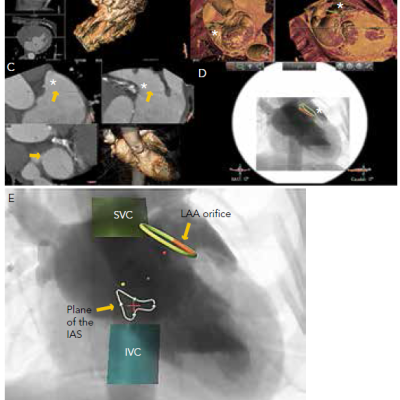 Figure 3 Measurements of the Left Atrial Appendage LAA Ostium in a Three-dimensional Computed Tomography Reconstruction and Integration of Structures of Interest into a Fluoroscopic Image by Using the 3mensio Structural Heart Software