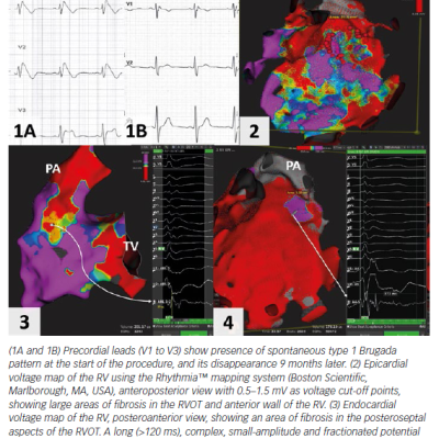 Figure 3 Normalisation of Brugada ECG After Epicardial Catheter Ablation in the RVOT