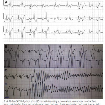 Onset of VF Triggered by Monomorphic Premature Ventricular Contraction
