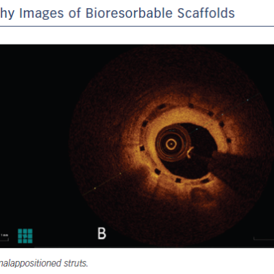 Figure 3 Optical Coherence Tomography Images of Bioresorbable Scaffolds