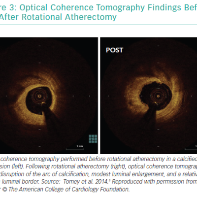 Optical Coherence Tomography Findings Before and After Rotational Atherectomy