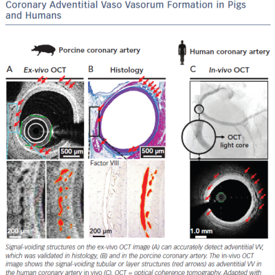 Figure 3 Optical Coherence Tomography Images of Coronary Adventitial Vaso Vasorum Formation in Pigs and Humans