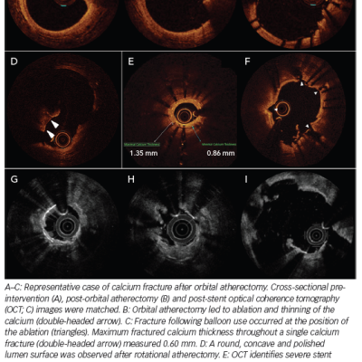 Optical Coherence Tomography Findings After Atherectomy Devices