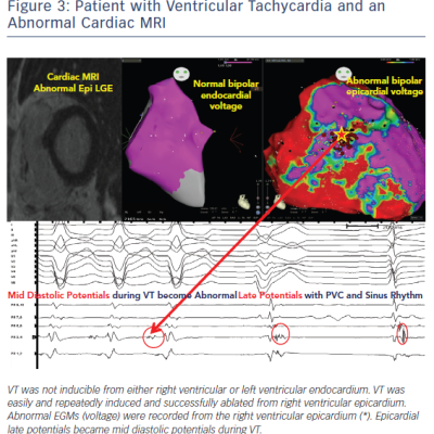 Patient with Ventricular Tachycardia &ampamp an Abnormal Cardiac MRI
