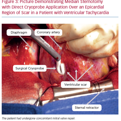 Picture Demonstrating Median Sternotomy