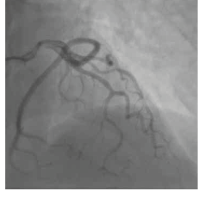 Figure 3. Poor opacification of the left coronary artery