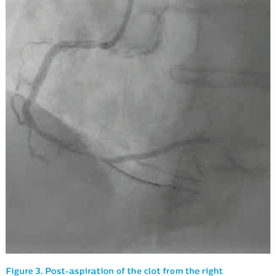 Figure 3. Post-aspiration of the clot from the right coronary artery