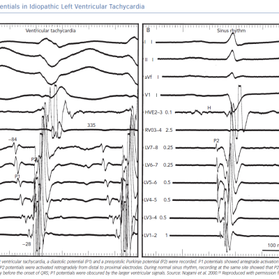 Potentials in Idiopathic Left Ventricular Tachycardia