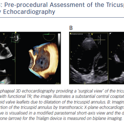 Figure 3 Pre-procedural Assessment of the Tricuspid Valve by Echocardiography